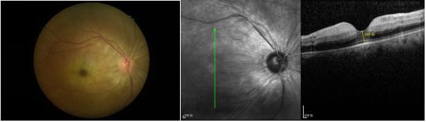 西安市第一医院“眼动脉溶栓术”助力24岁外省患者重获光明